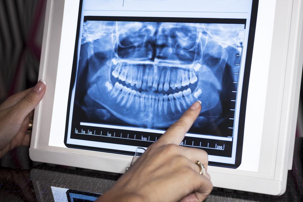 Digital X-Ray Dental
