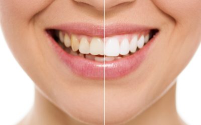 teeth whitening and bleaching