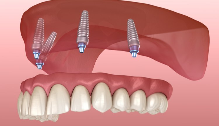 All on 4 Dental Implants in Miami