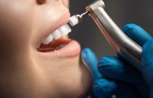 Procedure of teeth whitening for sensitive teeth
