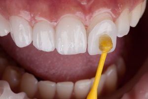 Dental veneers play an important role in cosmetic dentistry.