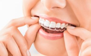 Teeth whitening with Invisalign is very popular nowadays.