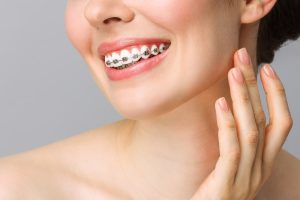 Beautiful woman with braces as an alternative to Invisalign. 