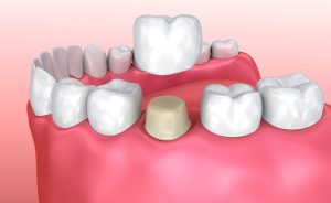 There are several significant differences between crowns and veneers. 