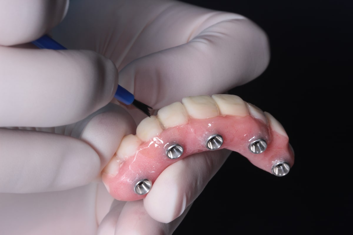 Prevent AllOn4 Dental Implants from Breaking 5 Proven Tips